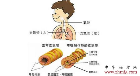 治支氣管哮喘驗方20則