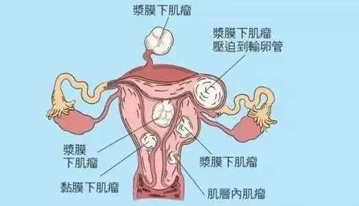 哪些女性容易得子宮肌瘤 這8種人群要注意預(yù)防子宮肌瘤