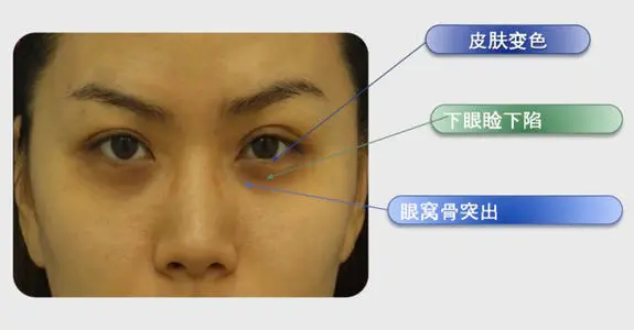 什么習(xí)慣導(dǎo)致長(zhǎng)黑眼圈 有效去除黑眼圈的4種方法