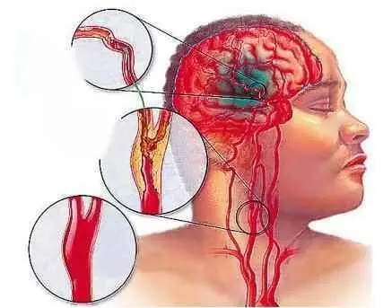 突發(fā)腦溢血的急救方法有哪些 腦溢血緊急處理的方法