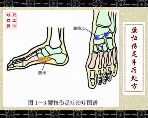 腰扭傷足療方