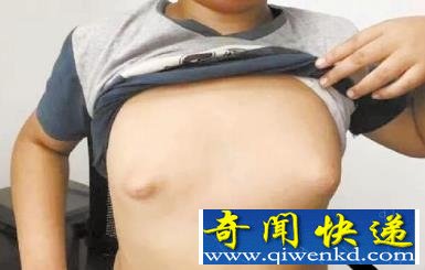 姐姐1個(gè)胸6斤重 姐弟乳房發(fā)育過(guò)大的元兇揭露