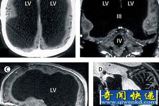 大腦神秘消失？美國男子大腦竟消失75%