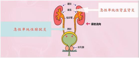 為什么有些人性生活后有尿感？有些人性生活后尿感的主要原因