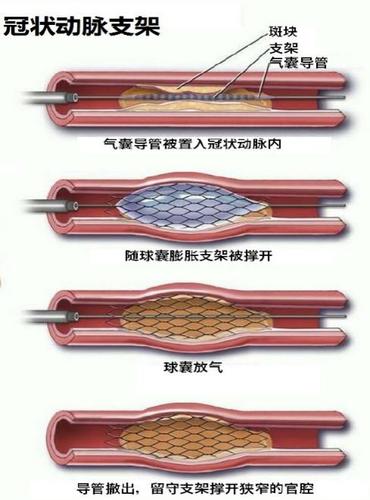 胎兒心臟支架有什么副作用(胎兒心臟支架有什么副作用嗎)