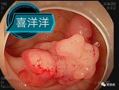 息肉結(jié)腸切除的副作用_息肉結(jié)腸切除的副作用是什么