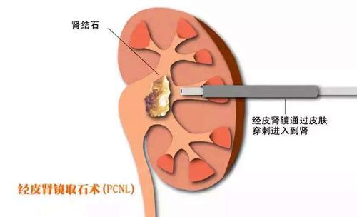 腎結(jié)石碎石有沒有副作用-腎結(jié)石碎石有沒有副作用和危害