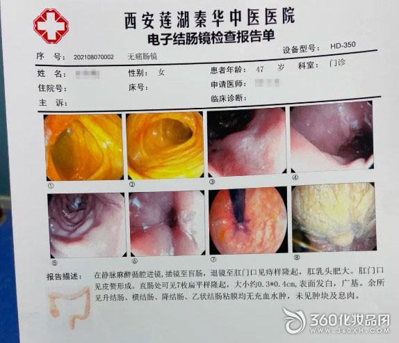 息肉結(jié)腸切除的副作用_息肉結(jié)腸切除的副作用是什么