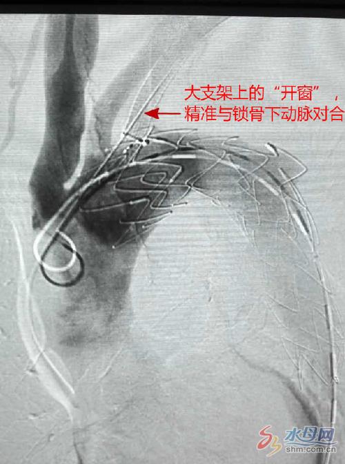 鎖骨下動脈支架副作用,鎖骨下動脈支架副作用是什么