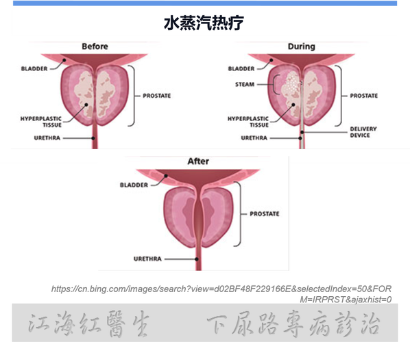 前列腺蒸汽消融術的副作用