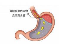 胃食管反流病癥狀-胃食管反流病癥狀分度