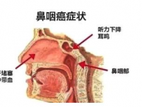 鼻咽癌的癥狀,鼻咽癌的癥狀和起因