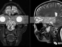 眼磁共振有什么副作用_眼磁共振有什么副作用和危害