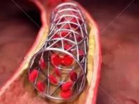 胎兒心臟支架有什么副作用(胎兒心臟支架有什么副作用嗎)