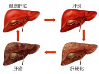 丙肝炎的早期癥狀_丙肝炎的早期癥狀表現(xiàn)有哪些