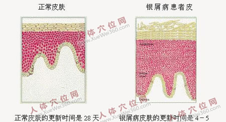 奇方治銀屑病130余例，有效率100%